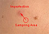 removing skin imperfections